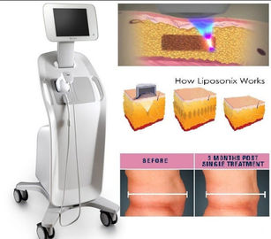Ultrason focalisé de forte intensité Liposonix amincissant Mchine, machine de lifting d'ultrason