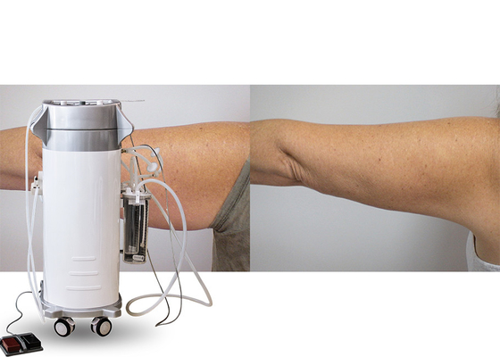 La puissance a aidé la machine chirurgicale de cavitation de liposuccion de vide pour des cuisses/bras/traitement arrière