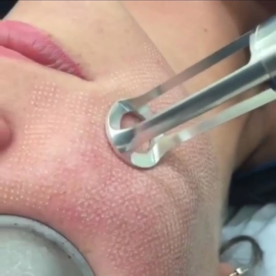 Machine chirurgicale de laser de cicatrice d'acné partielle portative du CO2 15w